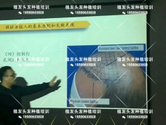 毛发移植技术能种植哪些部位？难不