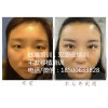 大家公认的双眼皮培训学校，学习几天费用多少？