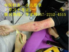 贵州乌当区中医针灸推拿培训班哪家