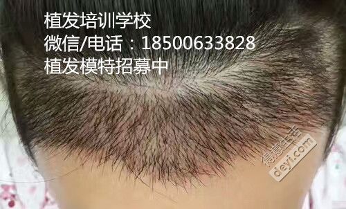 植发13_副本.jpg