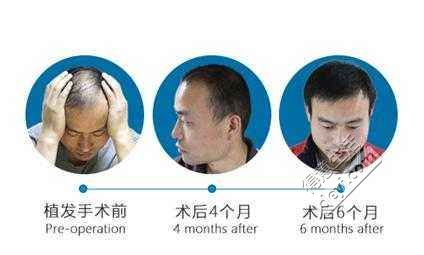 植发6.jpg