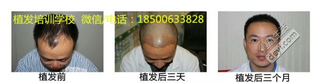 植发17jpg_副本.jpg