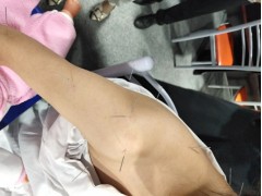 六盘水盘县哪里有中医针灸推拿快速