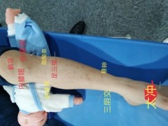 安顺普定县一个月的短期针灸推拿培